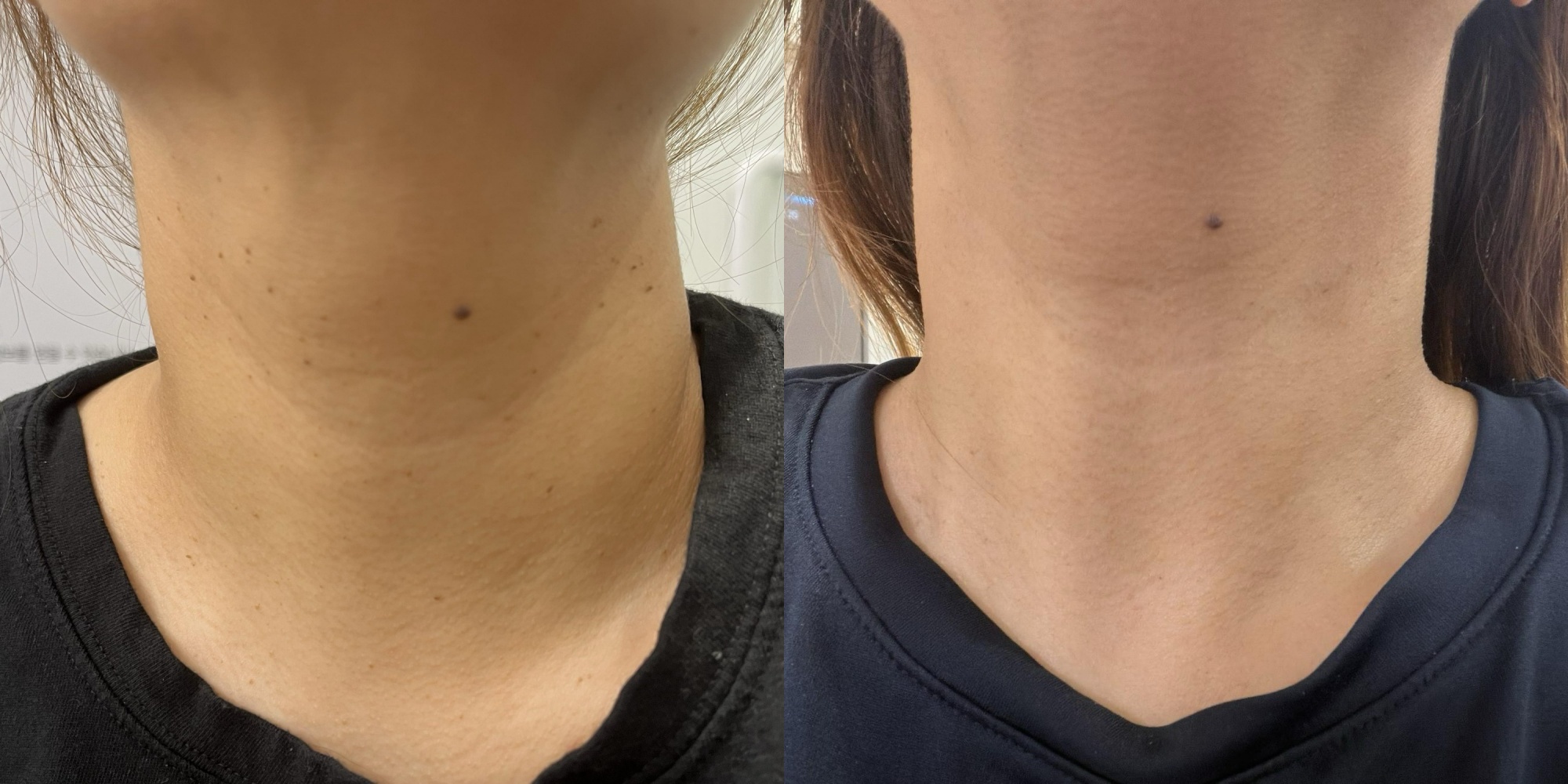 before-after-1